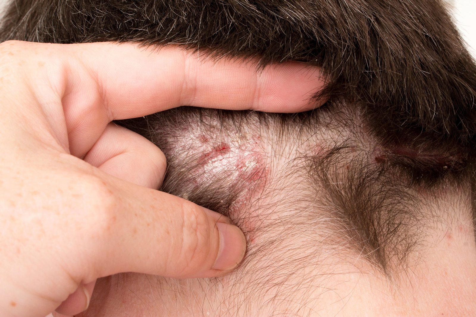 Psoriazė gydymas