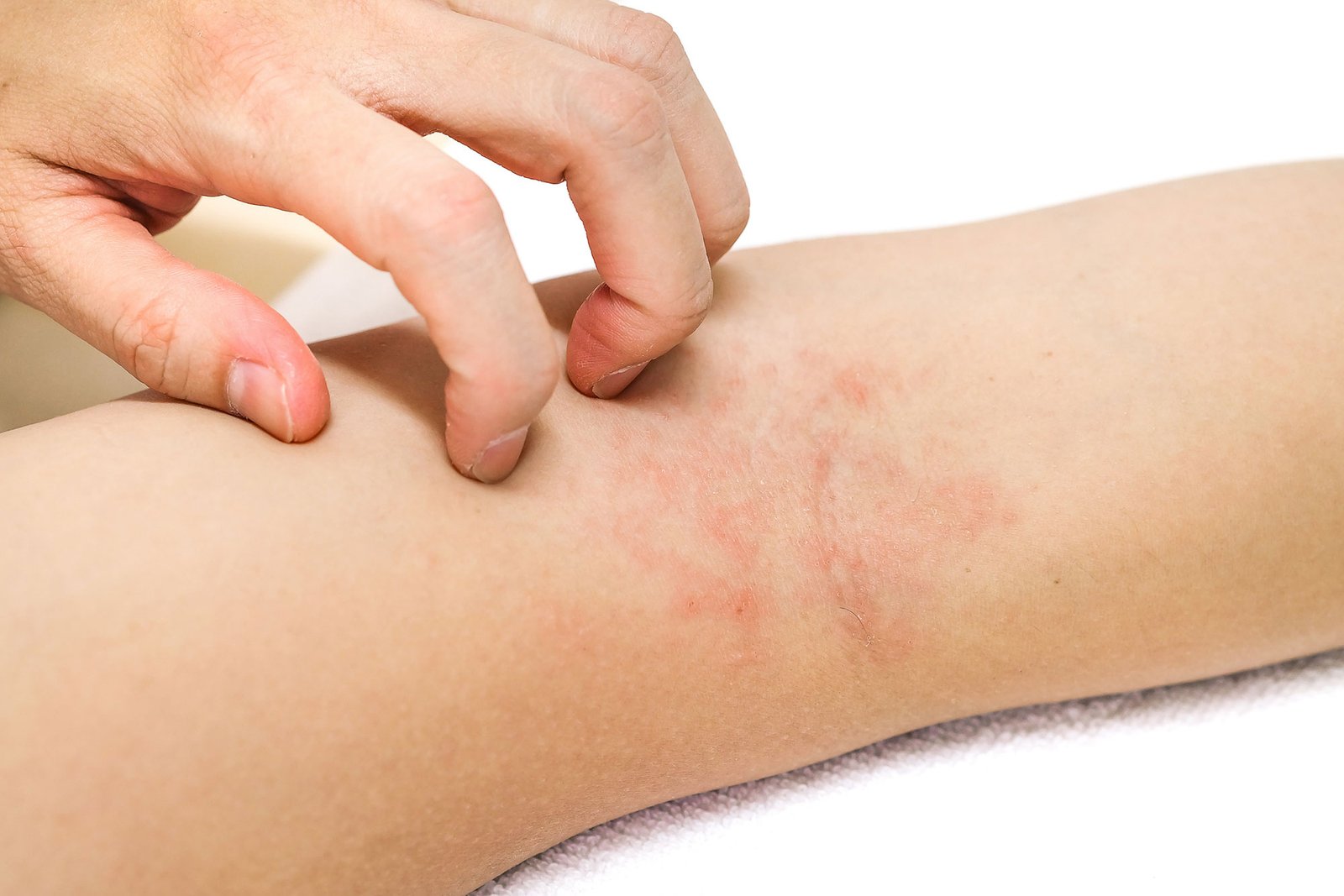 Psoriazė gydymas