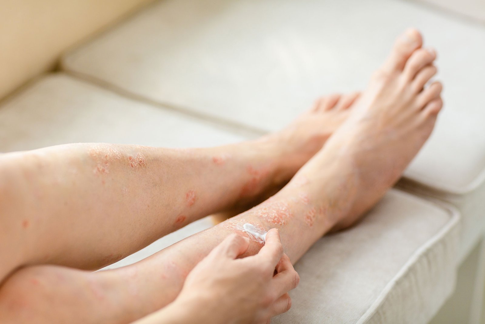 Žvynelinė psoriazė gydymas