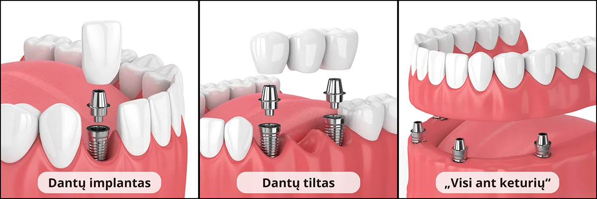 Dantų implantas